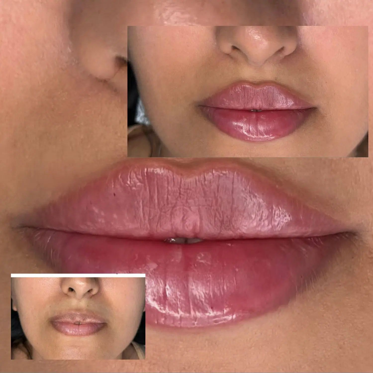 ژل و بوتاکس در کلینیک زیبایی