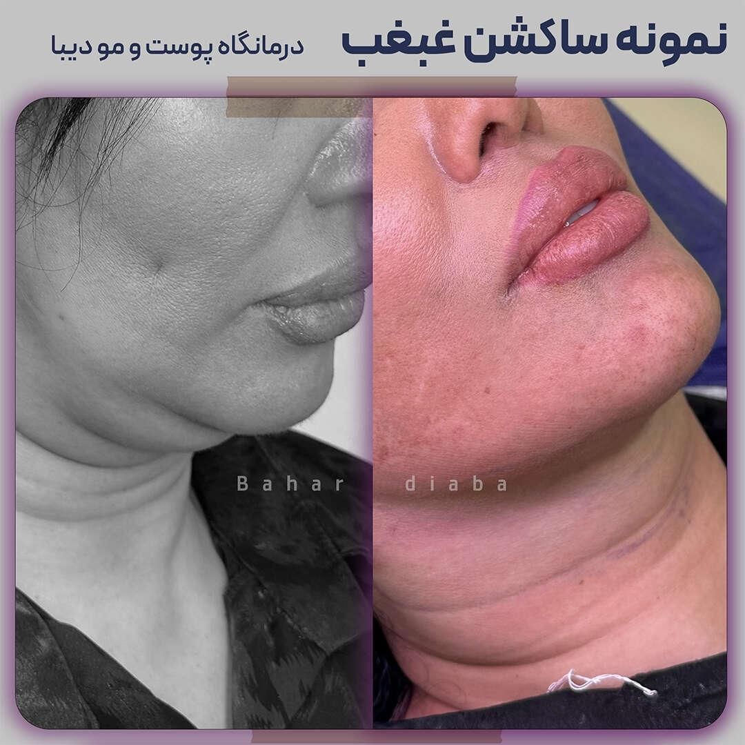 رفع و ساکشن غبغب 100% تضمین کتبی