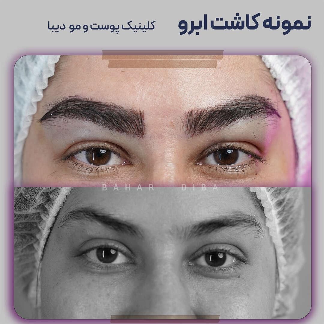 کاشت ابرو در حد ۱۰۰٪تضمین کیفیت