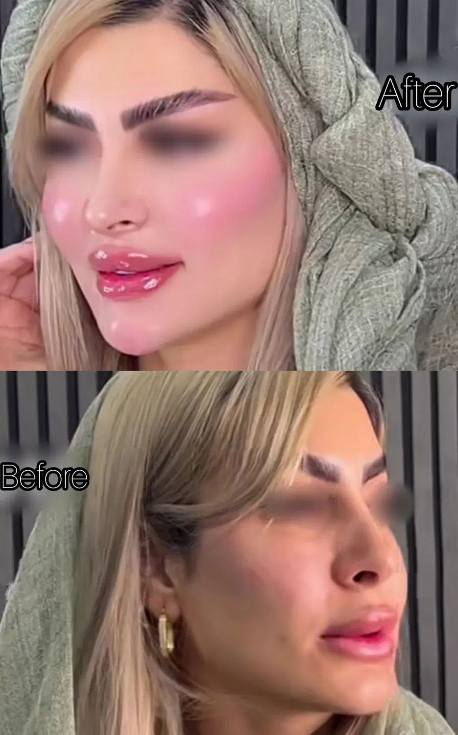 مدل چربی صورت،فرم دهی باسن و هیپ دیپ