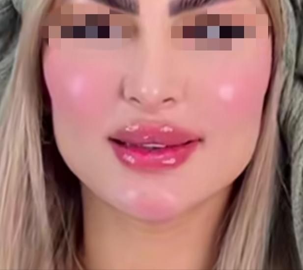 اقساطی آموزش جراحی ساکشن بلفارو ژل بوتاکس