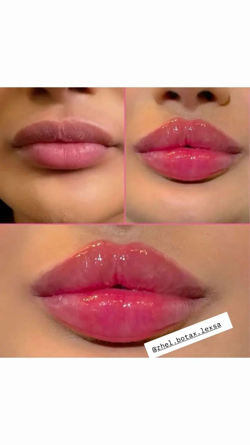 ژل و بوتاکس فیلر مزو