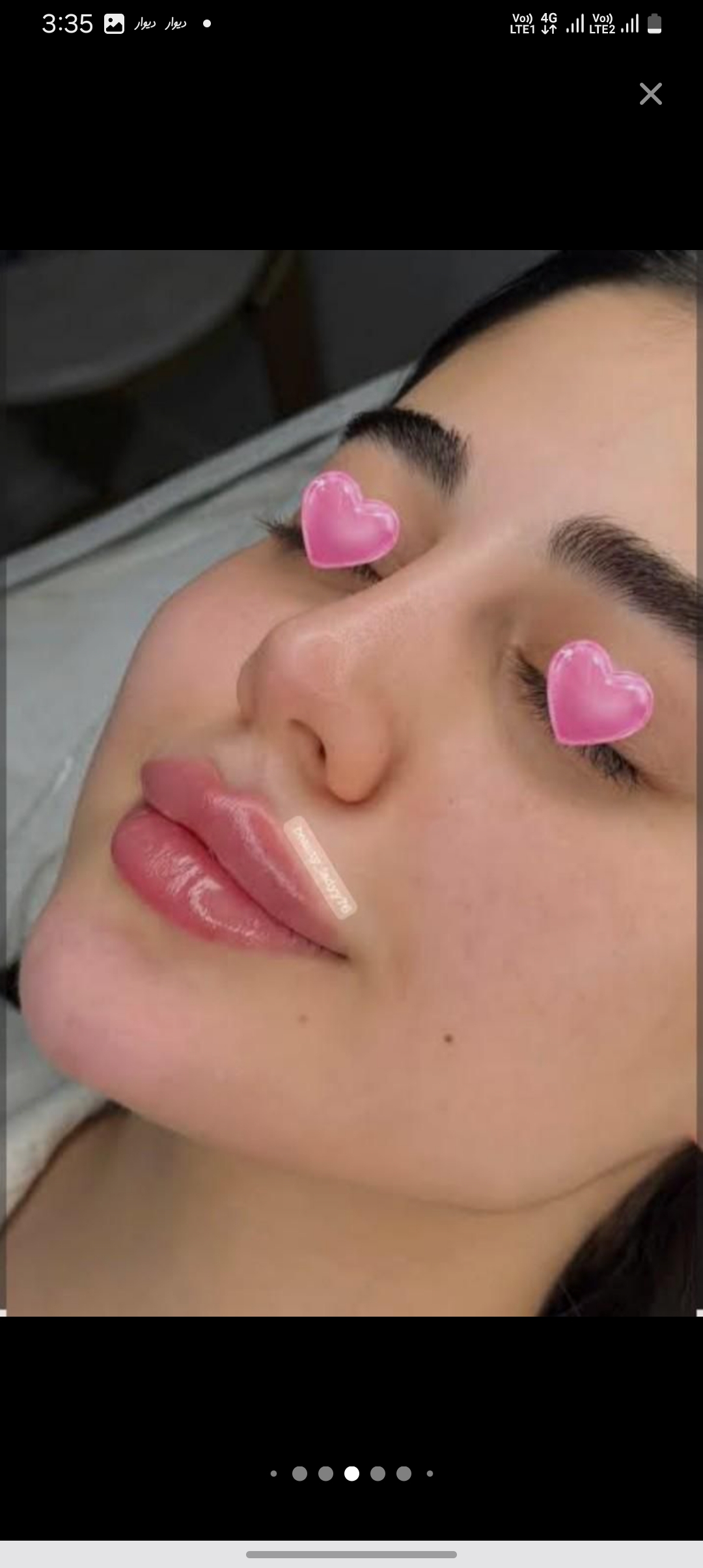 فیلر لب