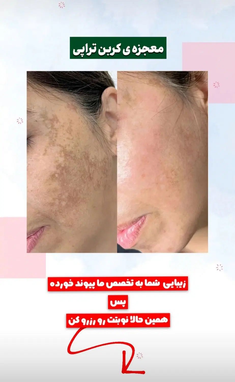 حذف تتو و روشن سازی نواحی تیره بدن با لیزر