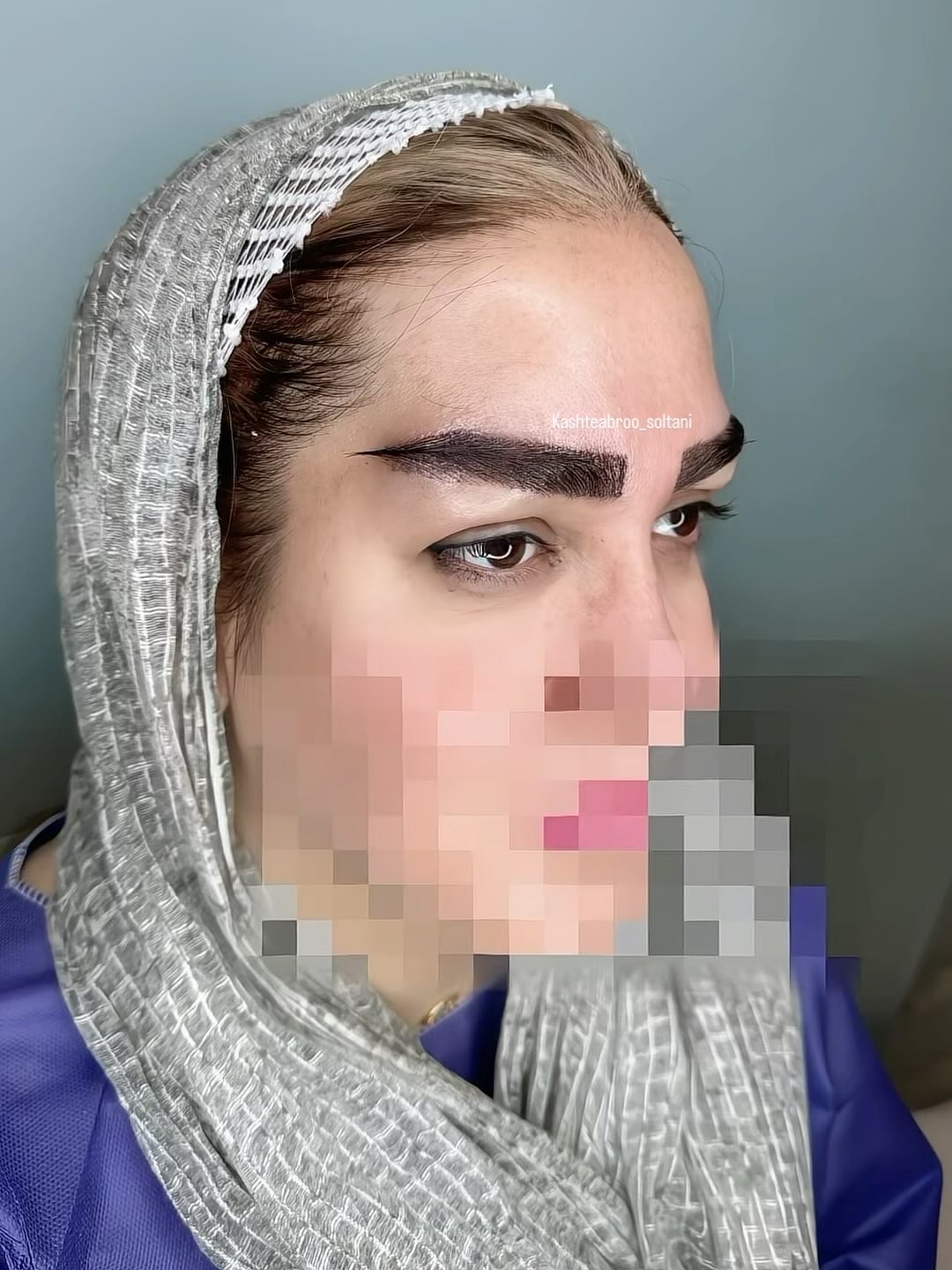 کاشت ابرو متدفاین برو