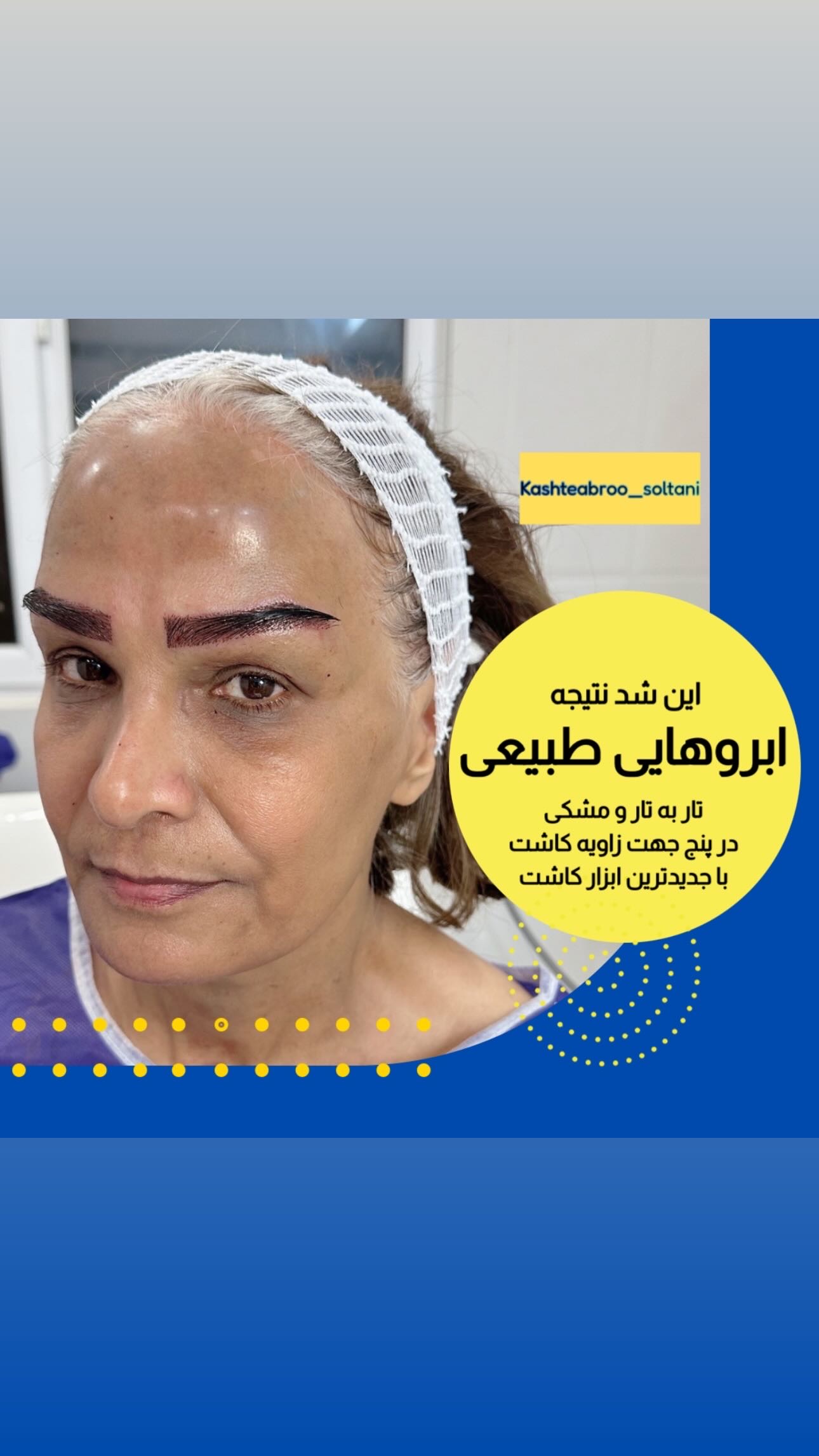 متدفاین برو کاشت با هفتاد درصد سفیدی مو در شیراز