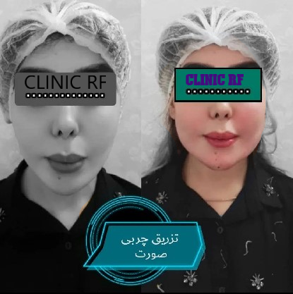تزریق چربی