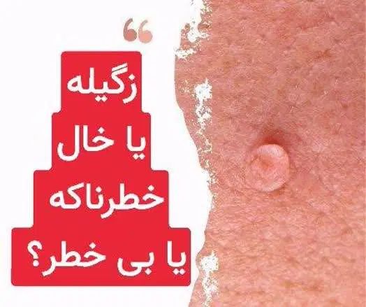 رفع تخصصی زگیل و زائدههای پوستی بدون برگشت