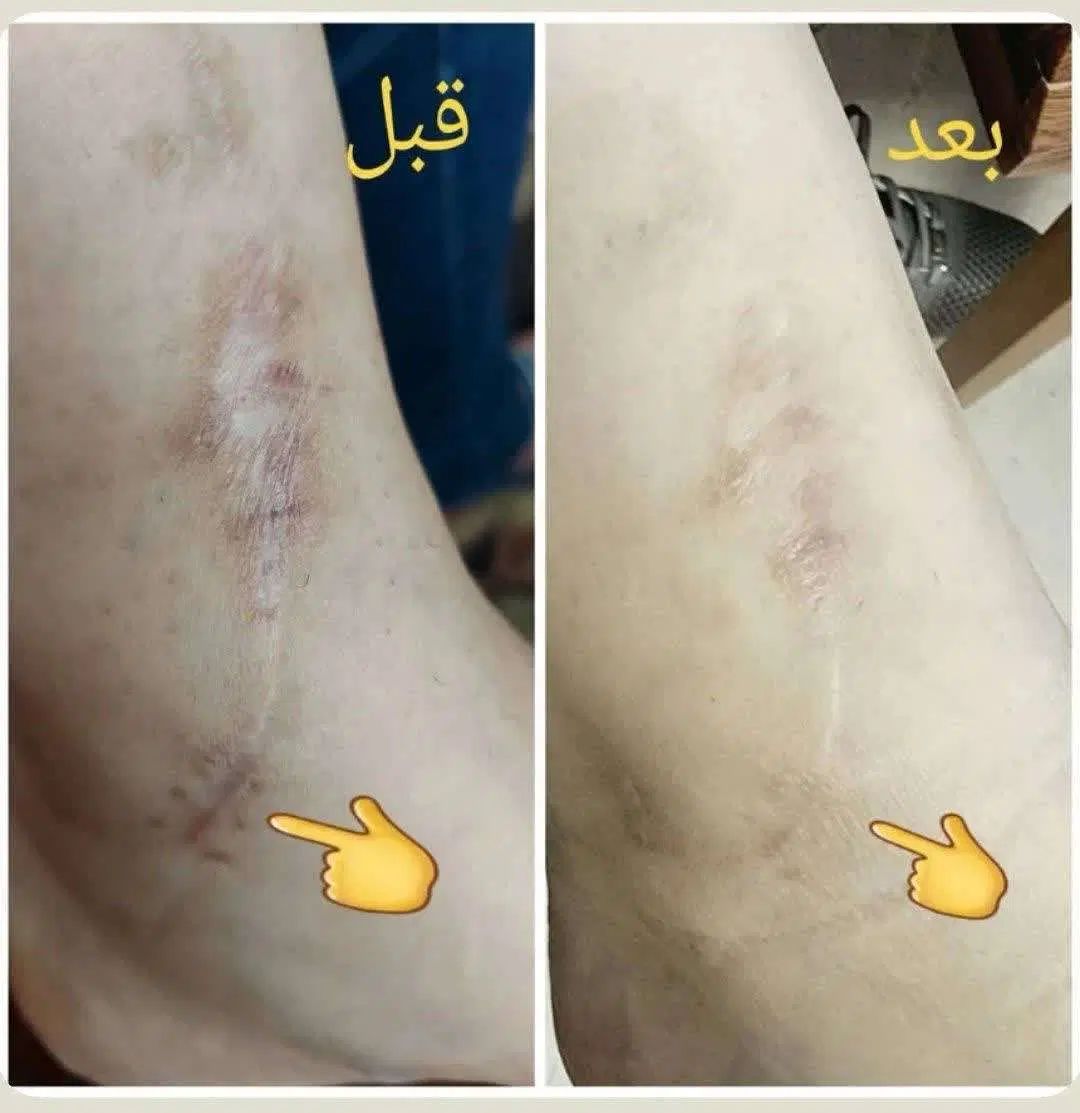 ترمیم اسکار و رفع رد بخیه و جای جوش