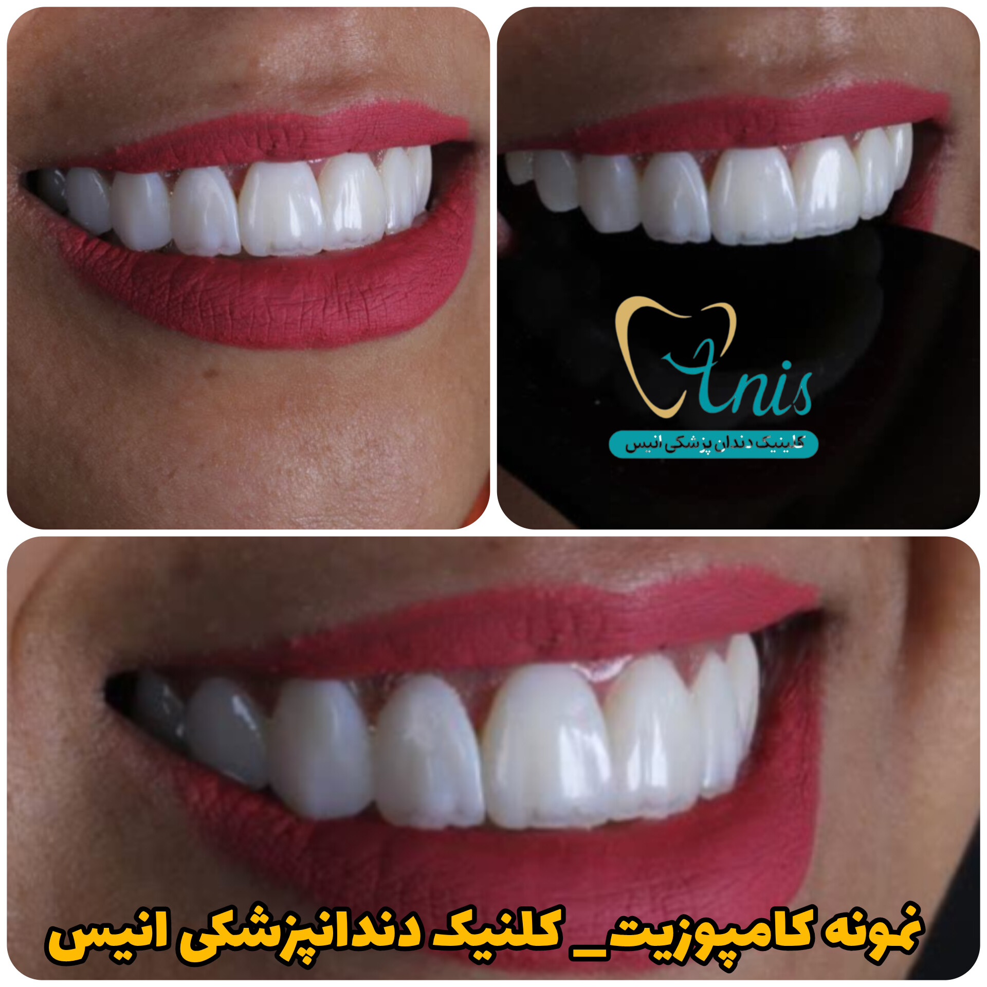 کامپوزیت دندان