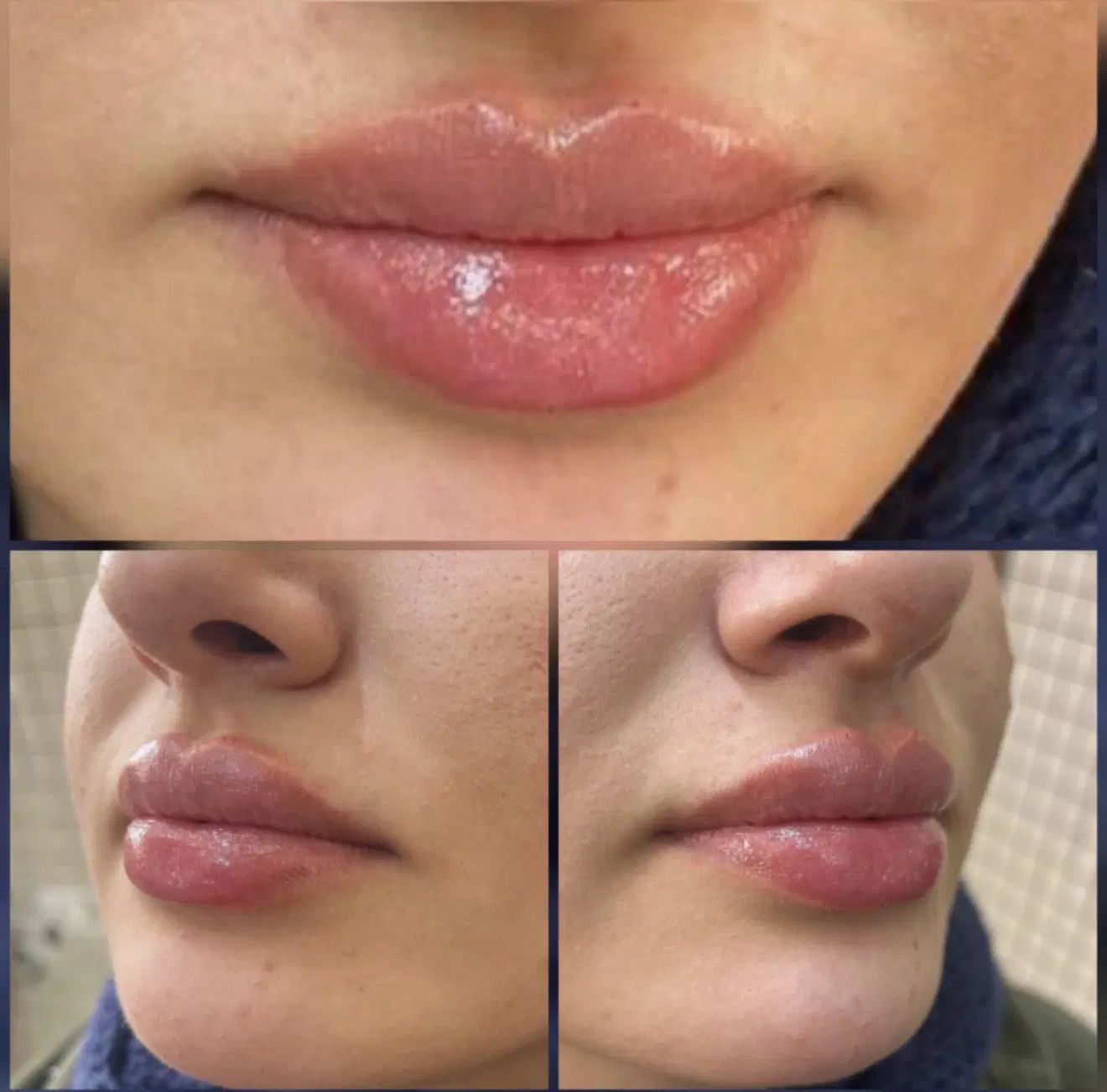 جشنواره ویژه تزریق ژل و مزو و پی آرپی درمطب