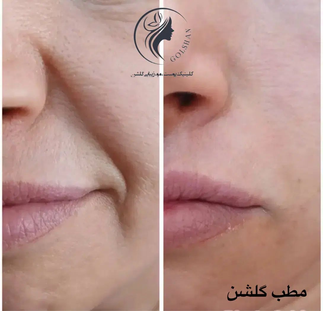 جشنواره ویژه تزریق ژل و بوتاکس و مزو پی آرپی درمطب