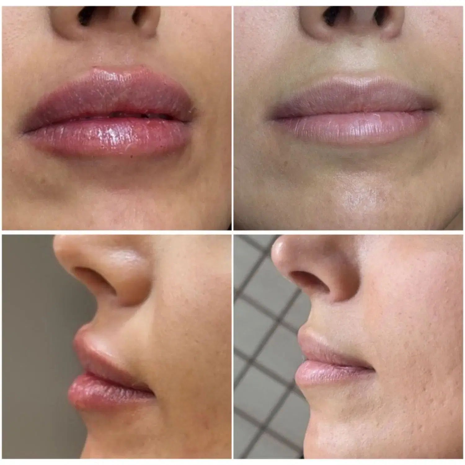 جشنواره ویژه تزریق ژل و مزو و پی آرپی درمطب
