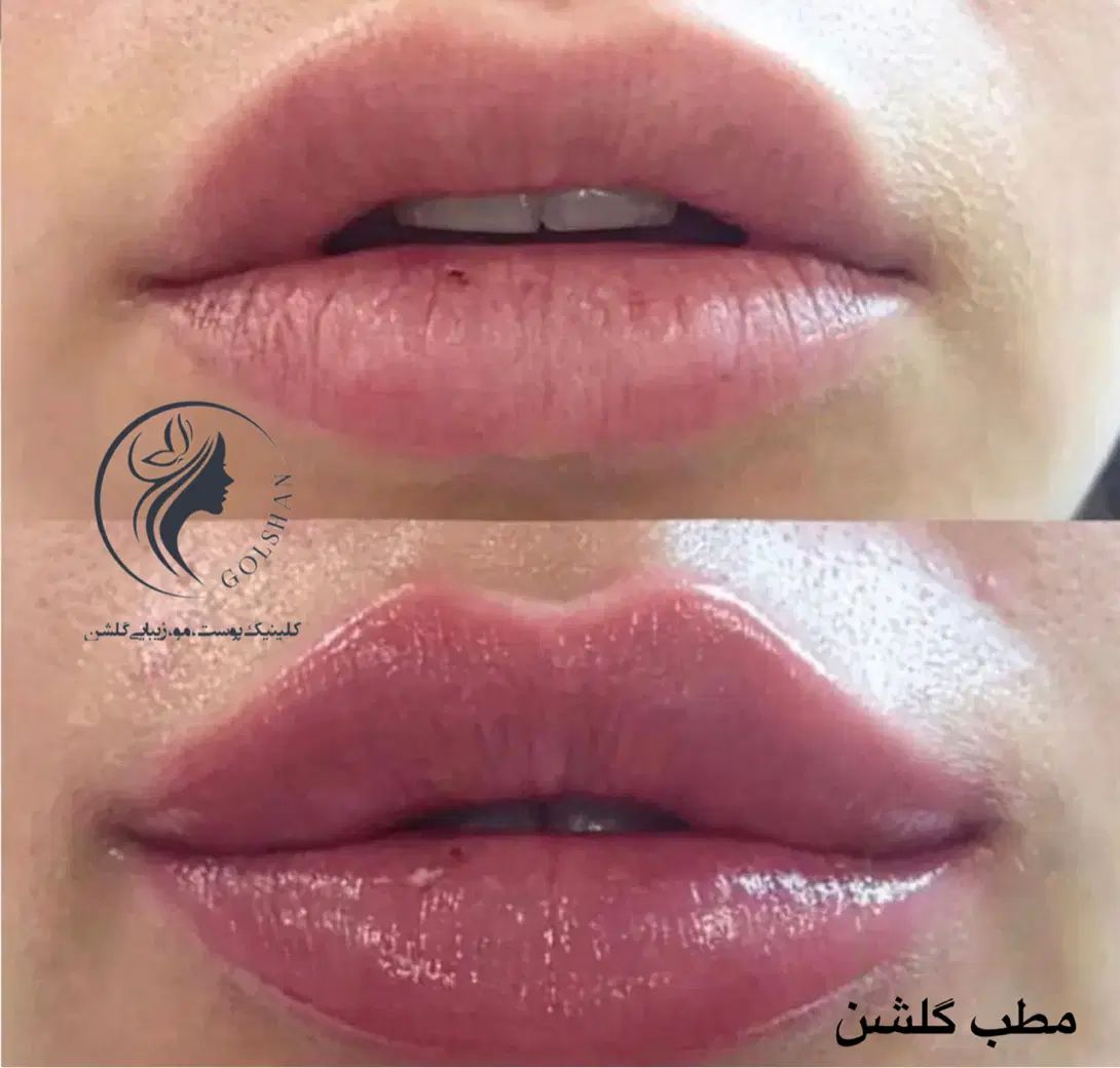 جشنواره ویژه تزریق ژل و بوتاکس و مزو پی آرپی درمطب