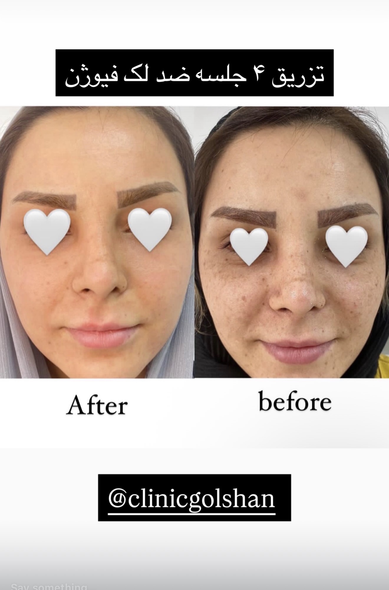 تزریق مزو مزوژل کوکتل و prp