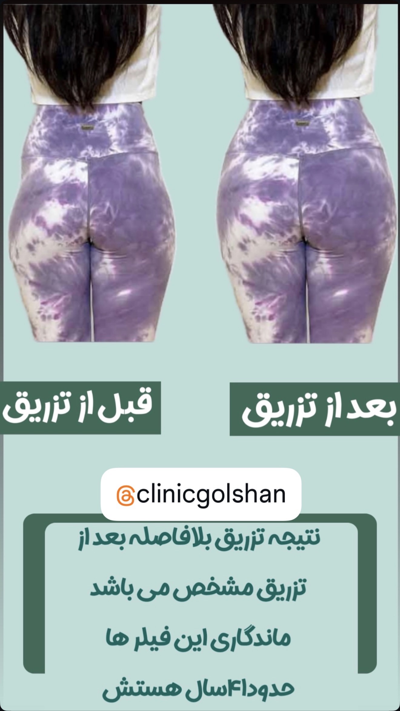 تزریق فیلر بادی هیپ دیپ دست باسن و پا