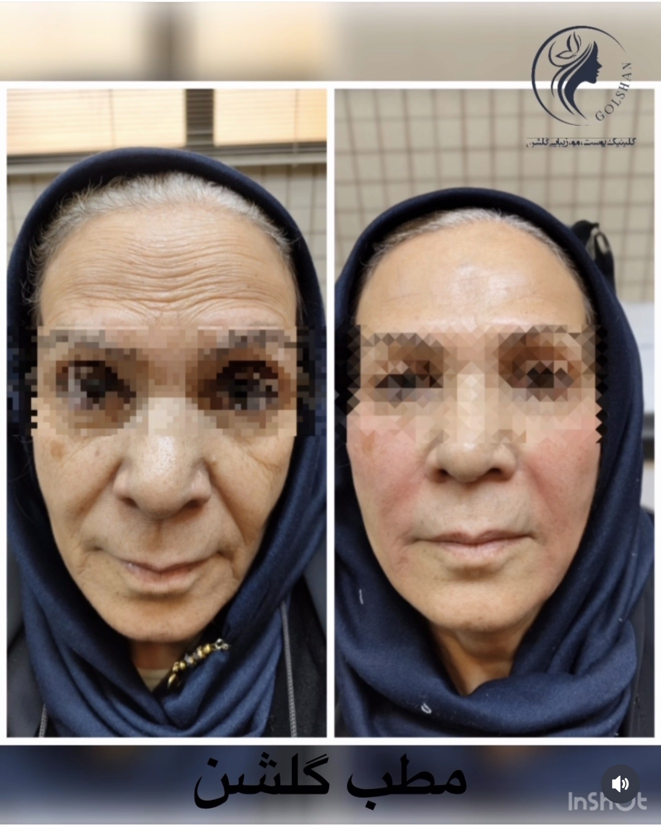 تزریق یک سی سی خط خنده