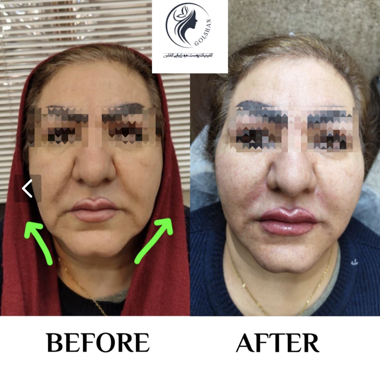 تزریق دو سی سی خط خنده