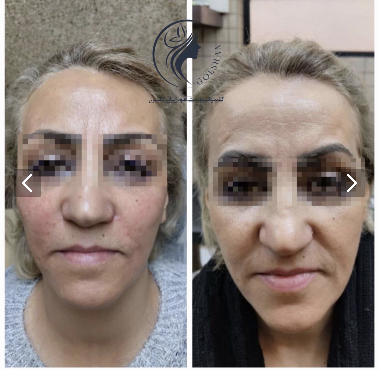 تزریق دو سی سی خط خنده