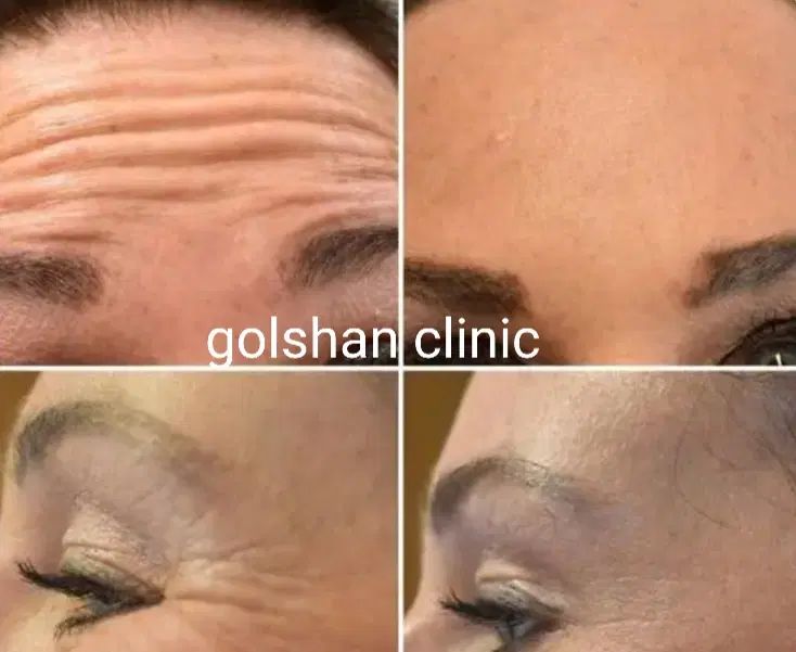 تخفیف استثنائی بوتاکس در مطب(جشنواره)