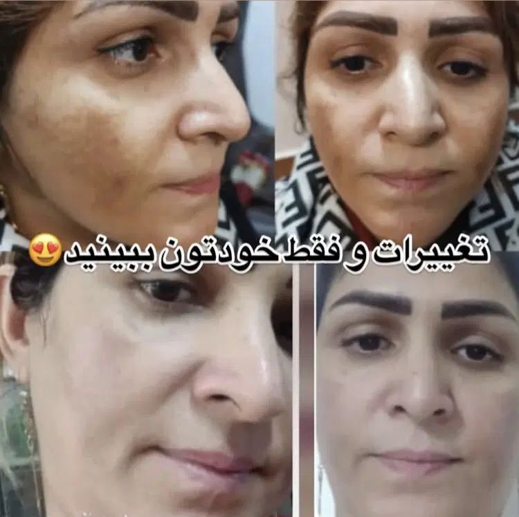 کرم بدن صورت ضدلک سفیدکننده تضمینی بی بازگشت