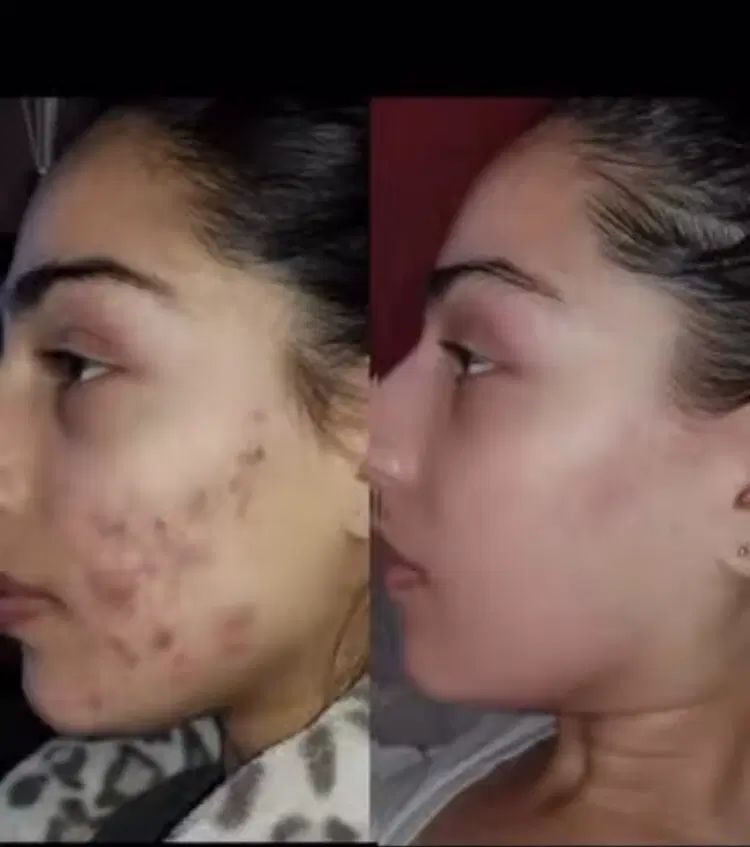کرم سفیدکننده ضدلک دائمی جوانسازجوش منافذصورت بدن