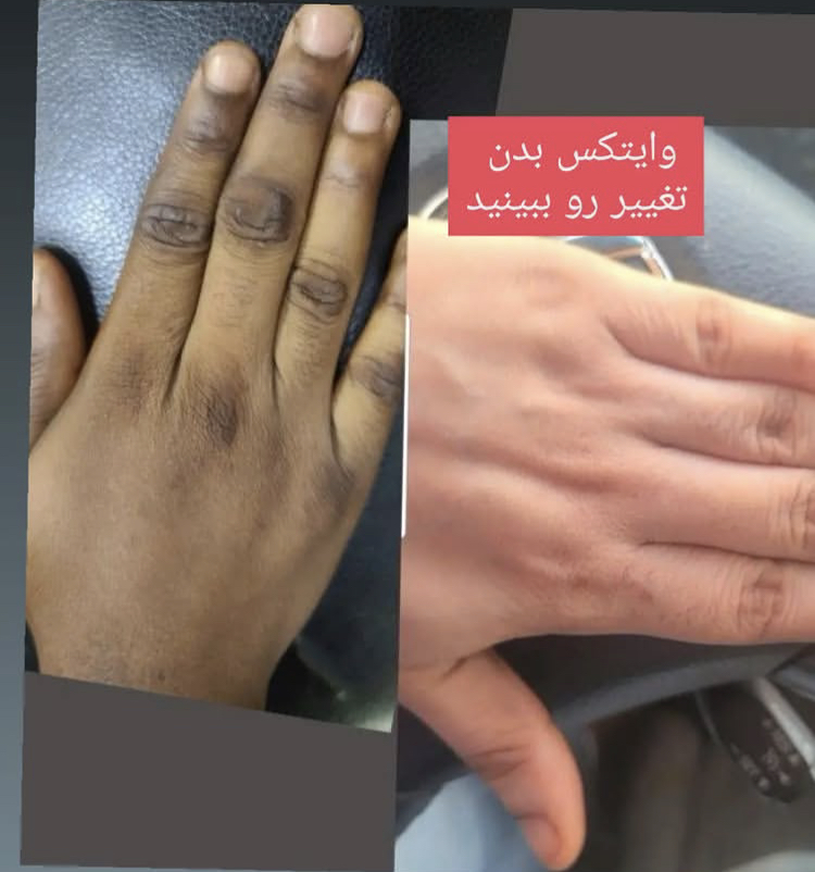 کرم سفیدکننده دایمی وایتکس پوست