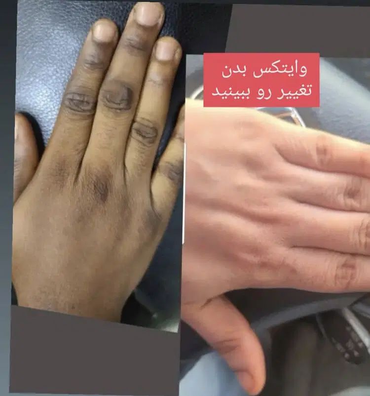 وایتکس بدن صورت ضدلک سفید روشن تضمین بدون بازگشت