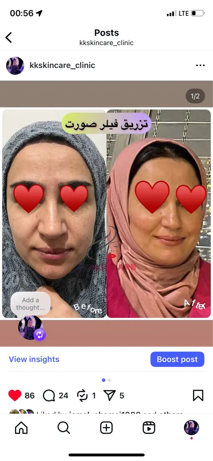اموزش کلیه خدمات زیبایی تزریقی در بکان