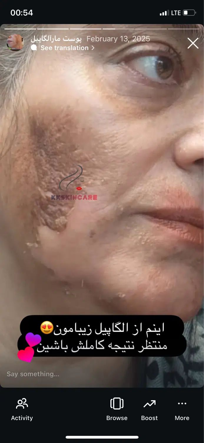 حذف لک و کک ومک وپینه پا بانوان و اقایان در بکان