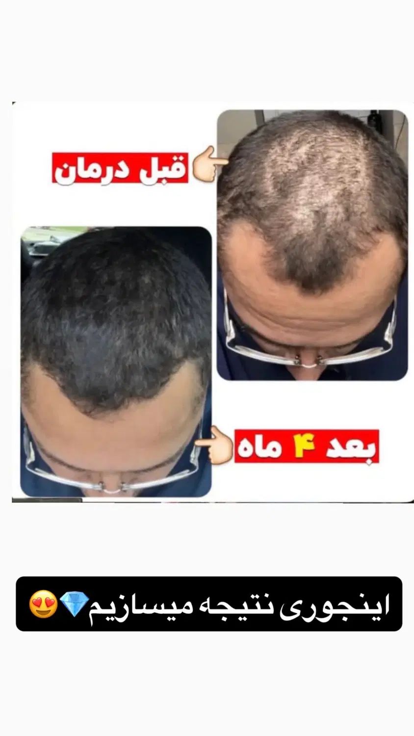 پک اگزونیک ، قطع ریزش مو و رویش مجدد مو