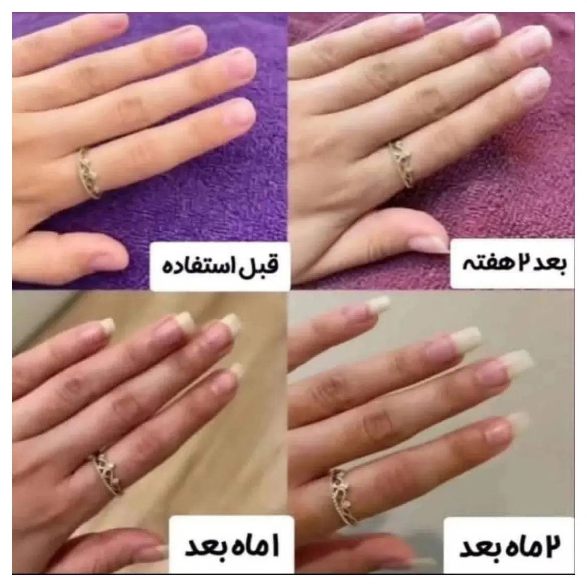 پک سرم تقویت ناخن افزایش رویش و رفع شکنندگی