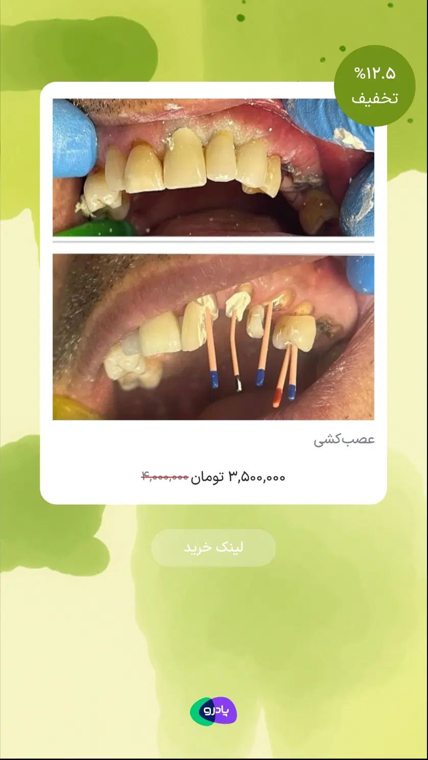 عصبکشی