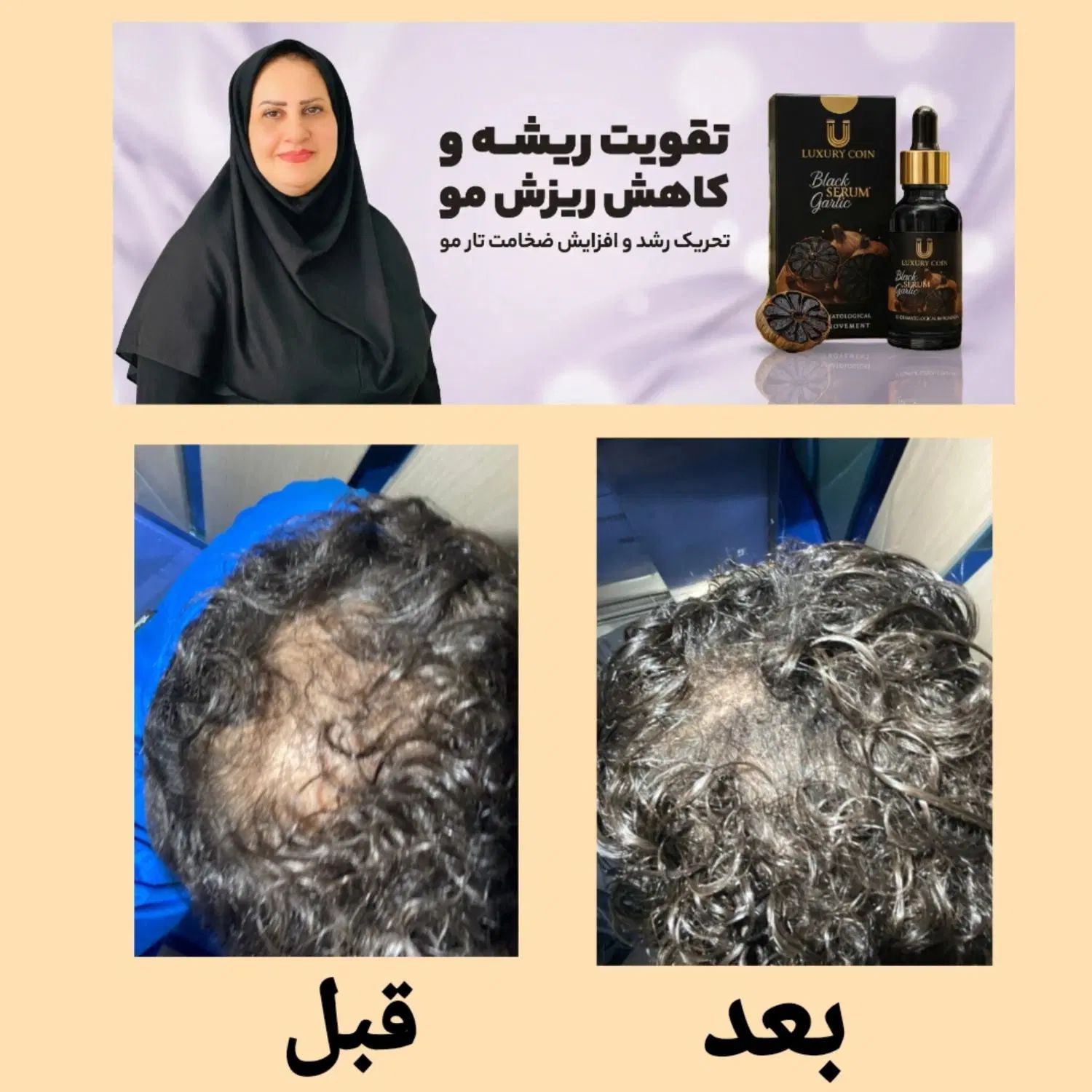 رفع قطعی ریزش مو و رویش مجدد