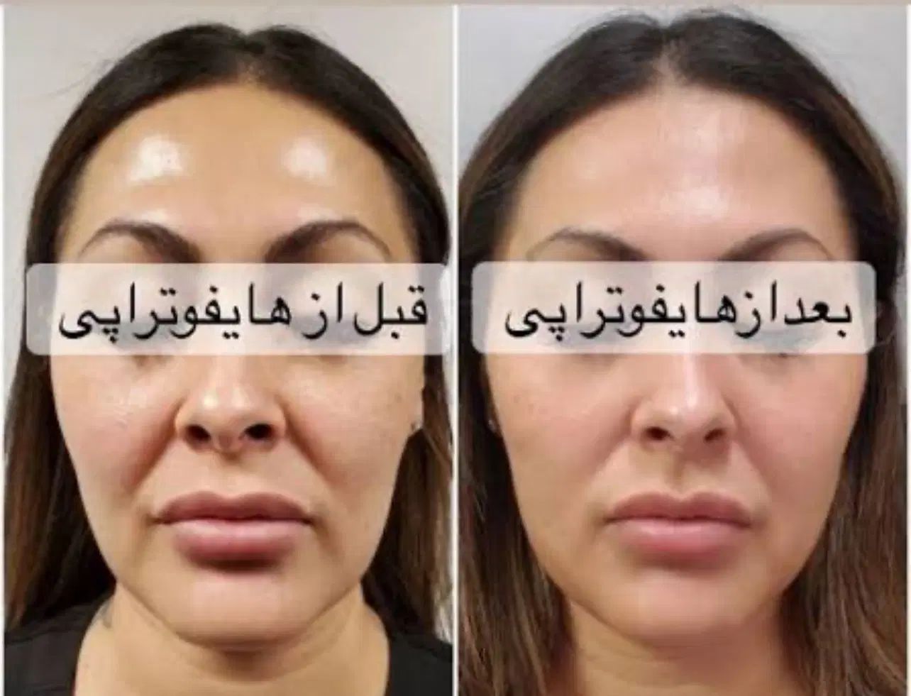 انجام خدمات فشیال،هایفو،برداشت خال در کلینیک تخصصی