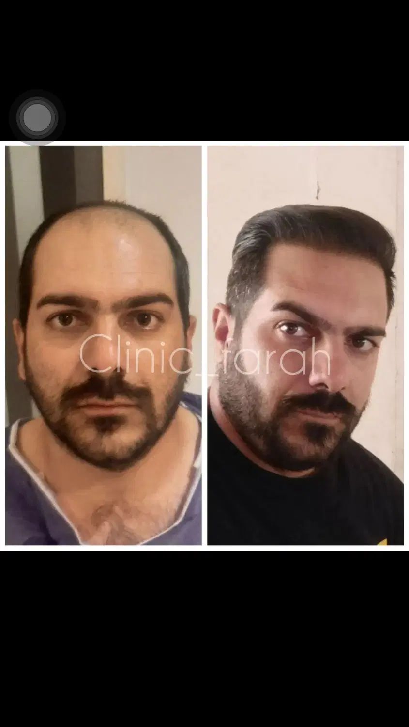کاشت مو و ابرو اقساطی کار کاشت توسط پزشک