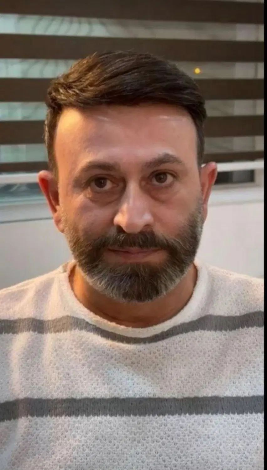 پروتز مو