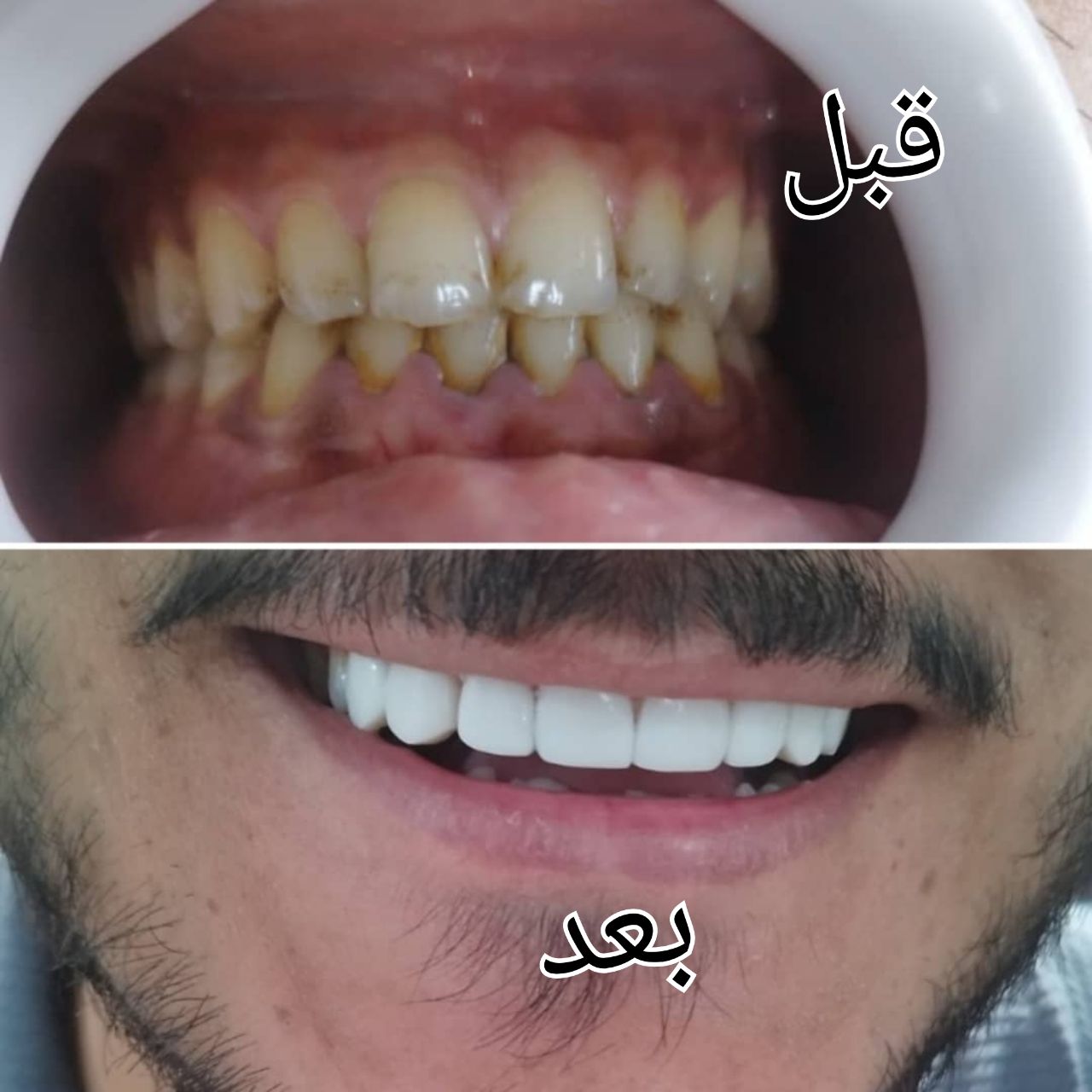 کامپوزیت دندان