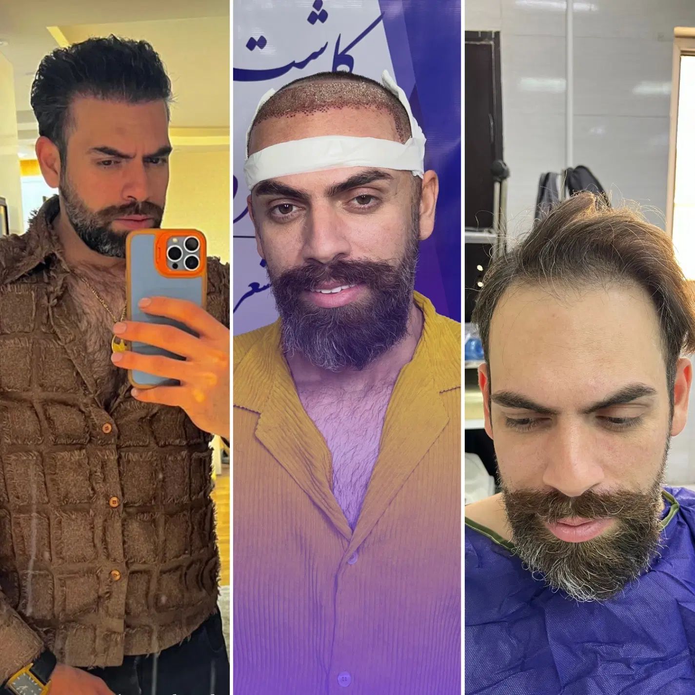 کاشت مو ابرو مزو و پی آر پی بوتاکس