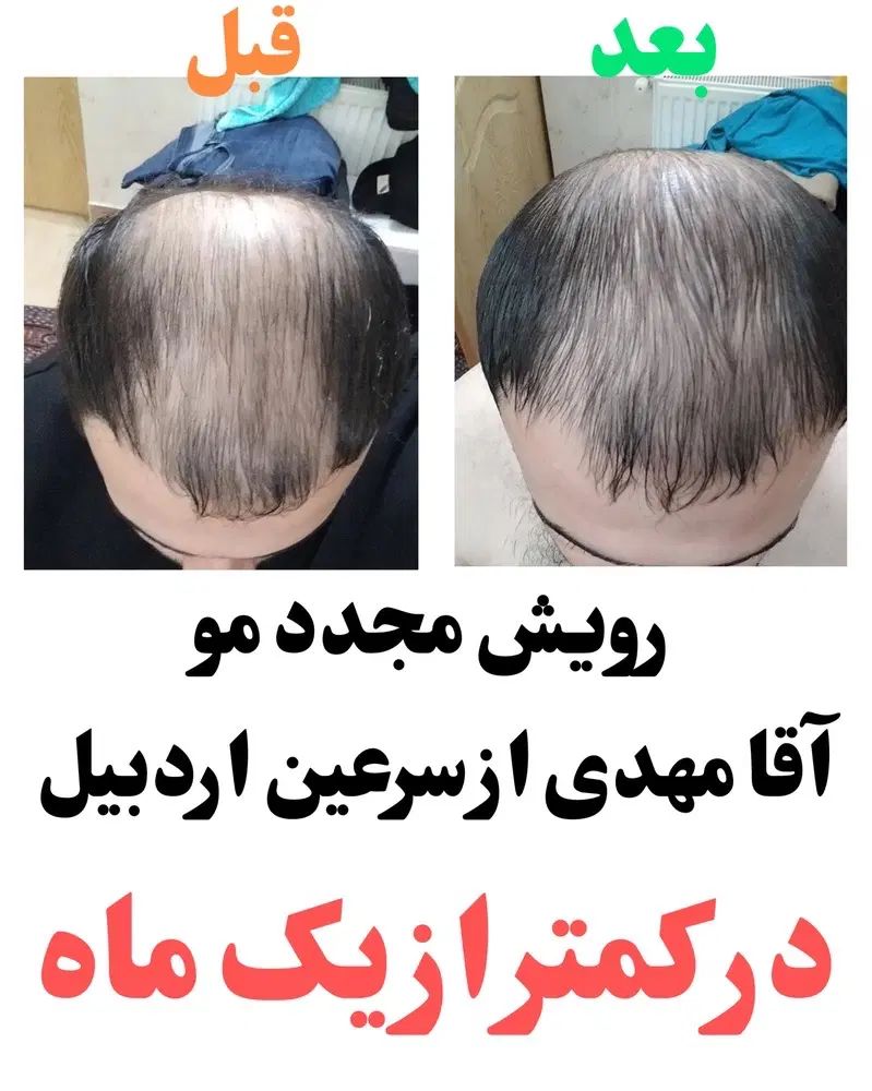 رویش مجدد مو و قطع ریزش مو