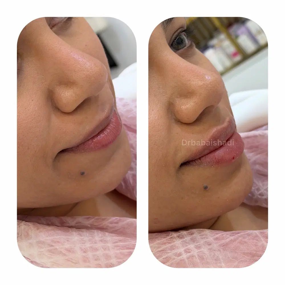 تزریقات نانوکلاژن،ژل،بوتاکس تخصصی دکتر شادی بابایی