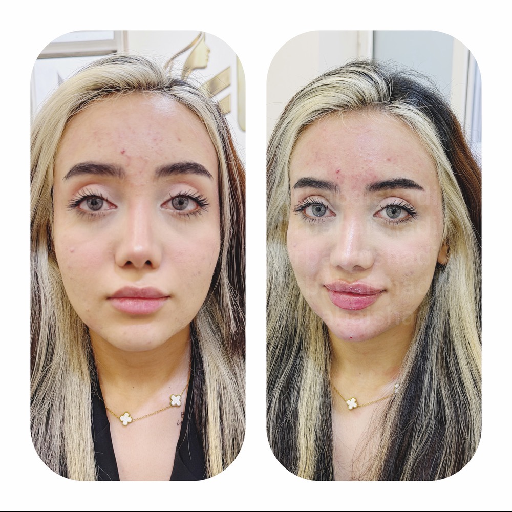 تزریق ژل لب و چانه و بوتاکس چشم گربه ای