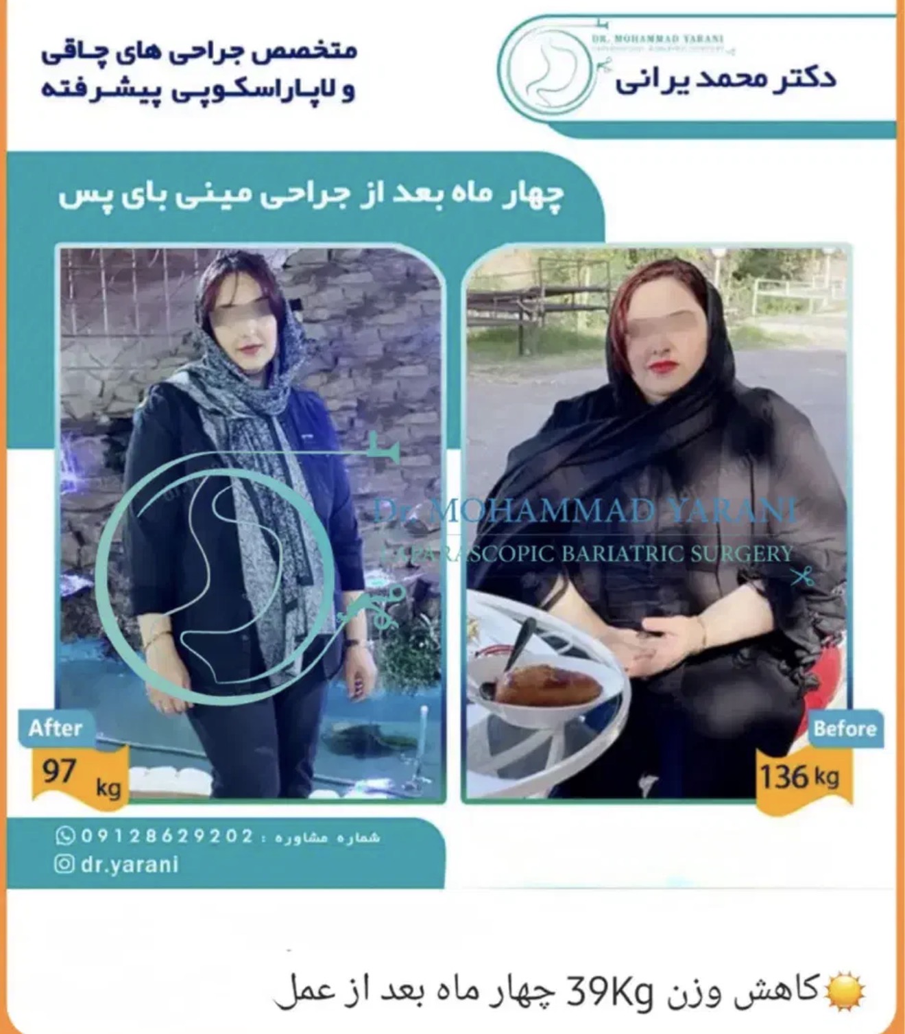 لاغری اسلیو معده با دکتر یرانی جراح با تجربه