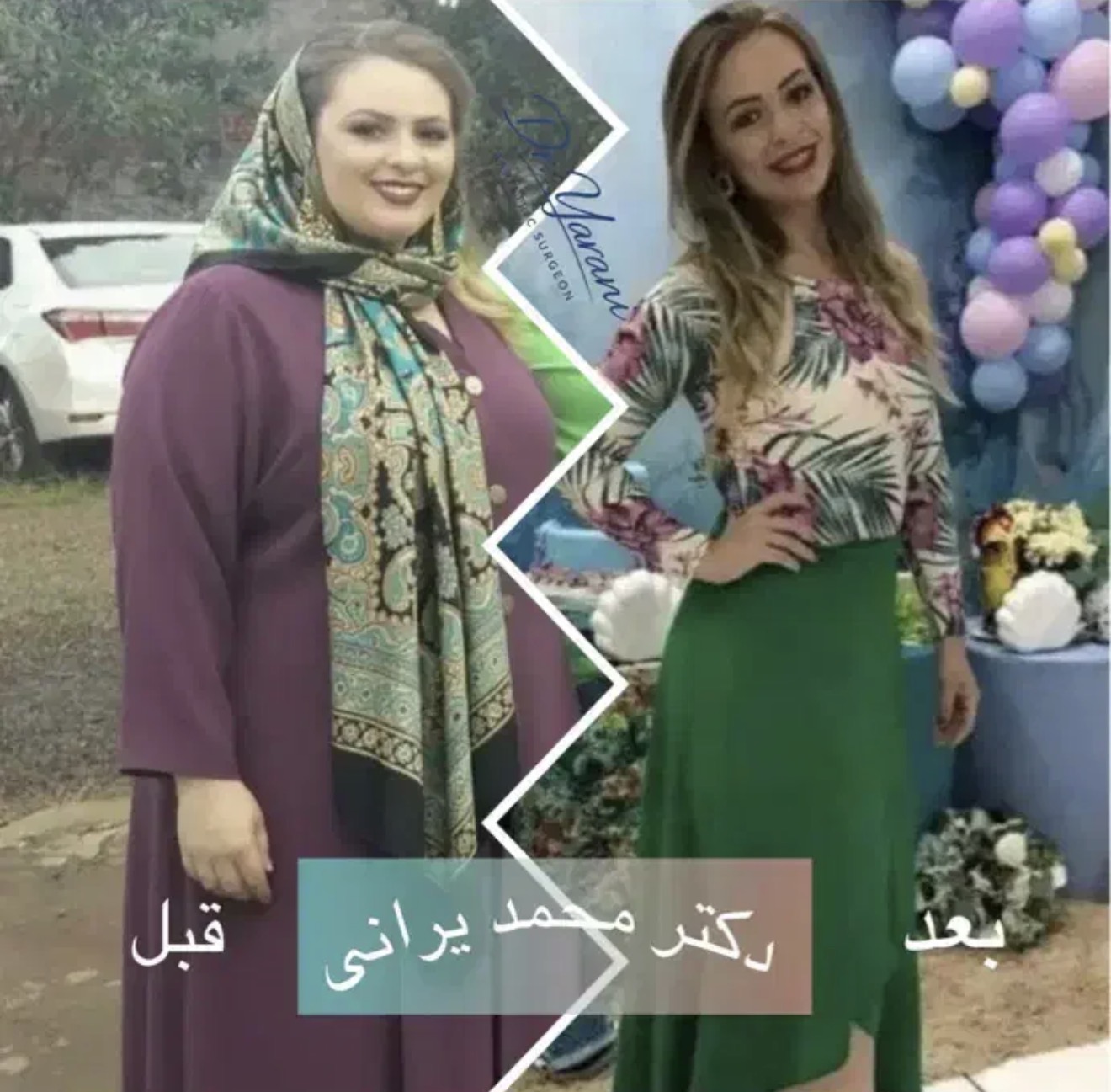 لاغری اسلیو معده با دکتر یرانی جراح با تجربه