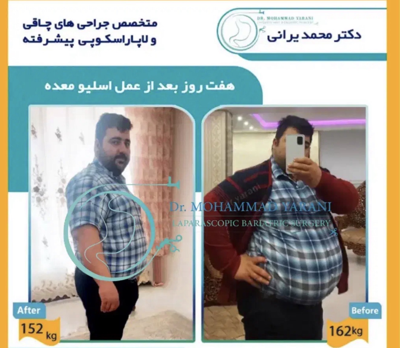 لاغری اسلیو معده با دکتر یرانی جراح با تجربه