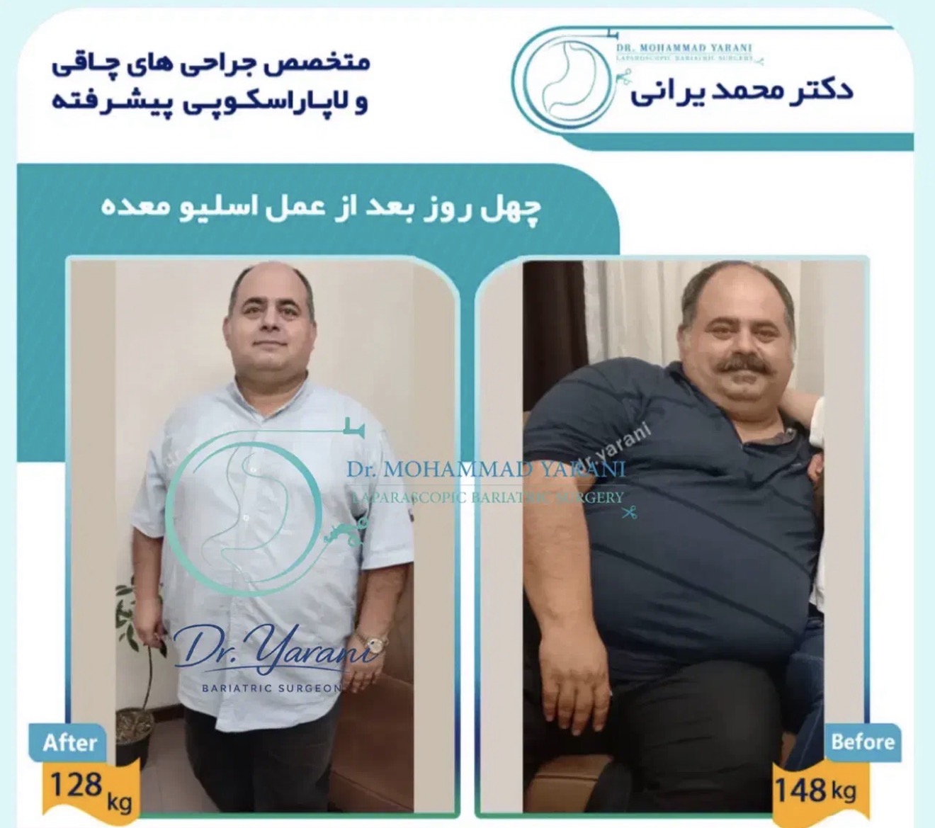 لاغری اسلیو معده با دکتر یرانی جراح با تجربه