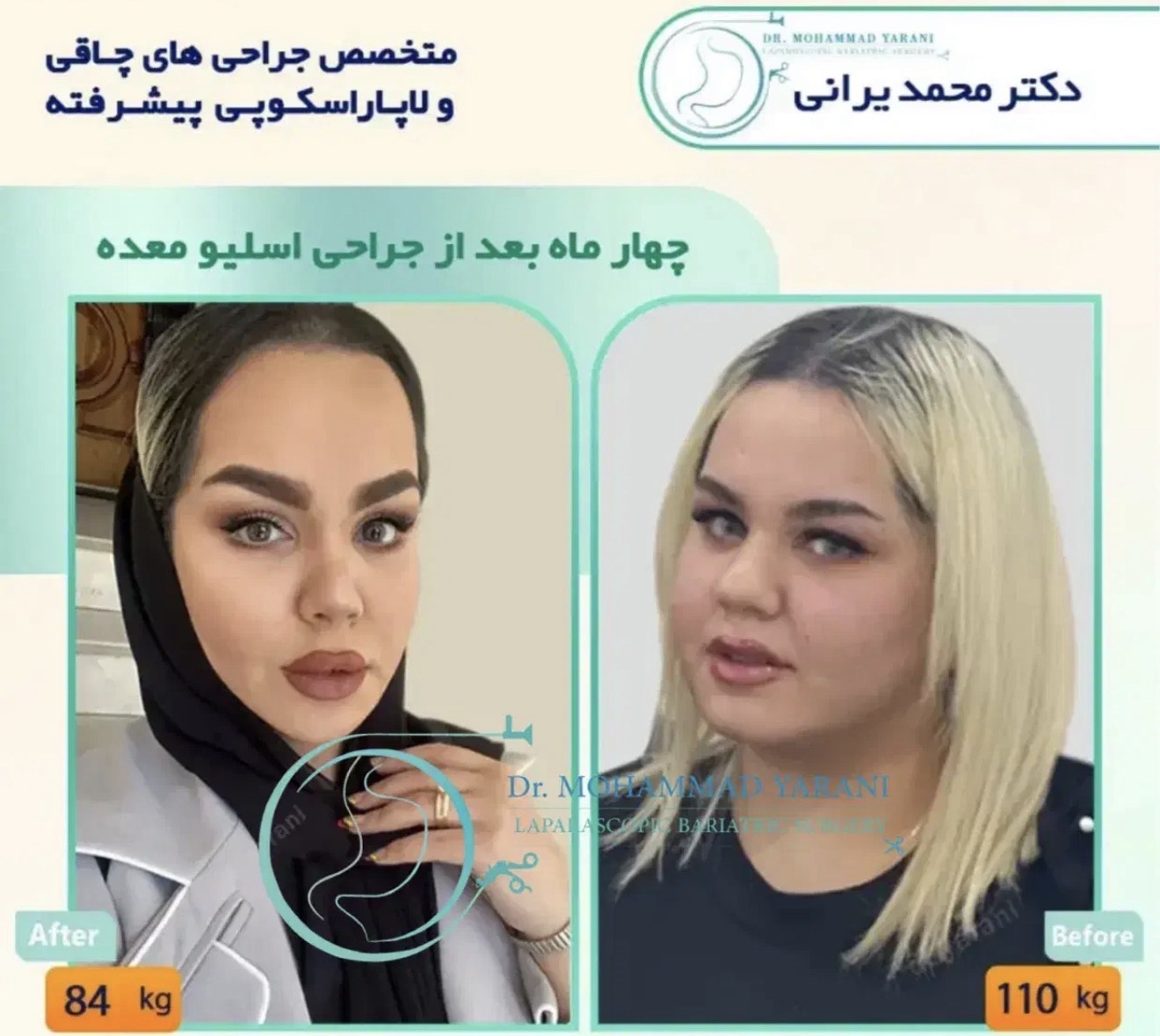 اسلیو معده با ⚜️ دکتر محمد یرانی⚜️جراح با تجربه