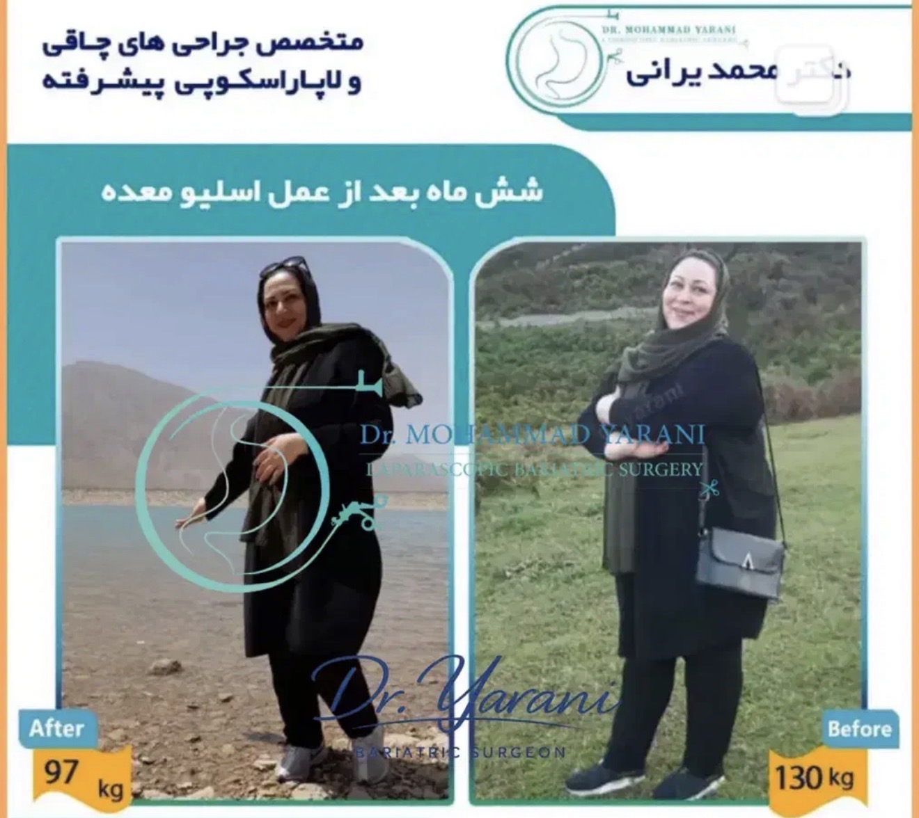لاغری اسلیو معده با دکتر یرانی جراح با تجربه