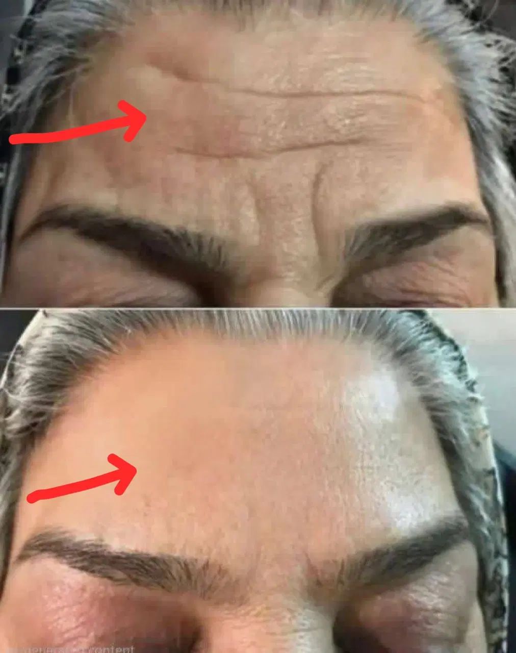 بوتاکس را فراموش کن