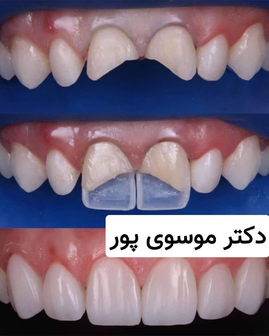 کامپوزیت با چک صیادی